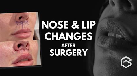 Nose Lip Changes After Surgery Dr Greg Bran YouTube