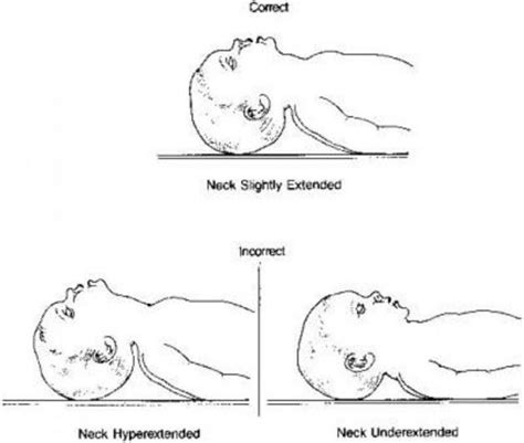 Pediatric Bls Pediatric Cpr Pediatrics Medical Illustration
