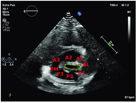 Parasternal Short Axis View Showing The Posteromedial Pm And