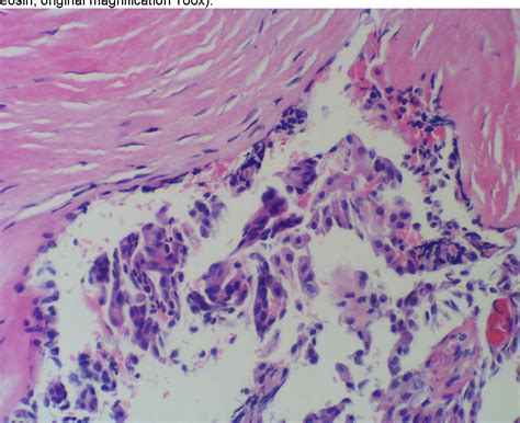 Figure 1 From Evaluation Of Cystic Salivary Gland Lesions By Fine