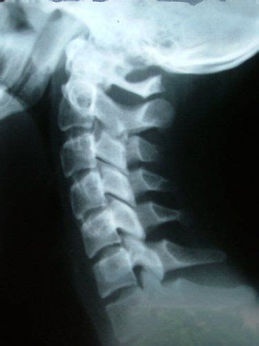 Chiropractic X-Ray - Spinecare Chiropractic - Adelaide Chiropractors