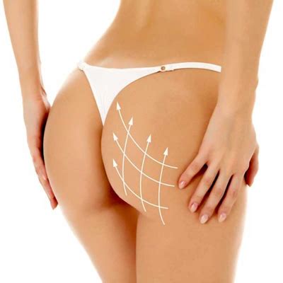 Gluteal Implants Dr Bouraoui Kotti Md