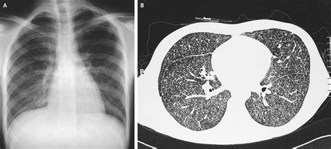 Miliary Tuberculosis Nejm