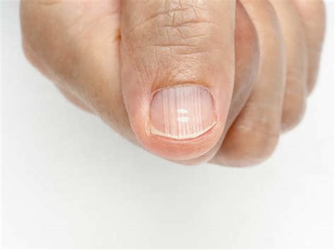 Infections Anemia Psoriasis What Nails Can Reveal About Your Health