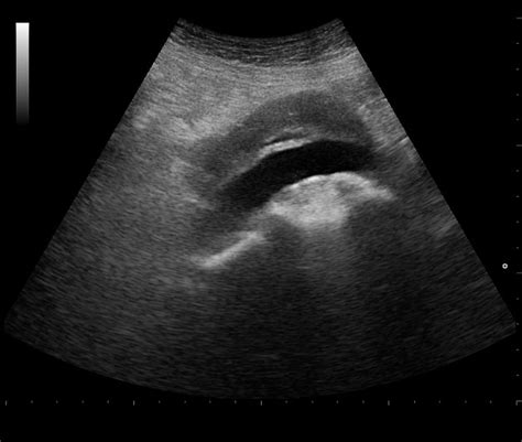 Aorta Ultrasound