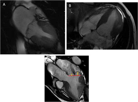 Bileaflet Mitral Valve Prolapse Visualized In A 2 Chamber A