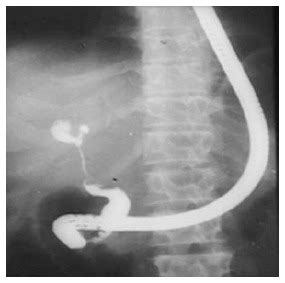 Endoscopic Management Of Hilar Biliary Strictures Abstract Europe Pmc