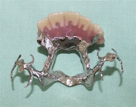 Partial Dentures (plates)