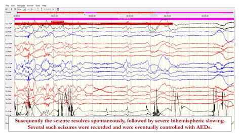 Eeg In Convulsive And Non Convulsive Seizures In The Intensive Care