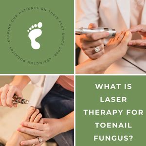 What Is Laser Therapy For Toenail Fungus