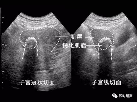 子宫肌瘤超声分类诊断中国医疗