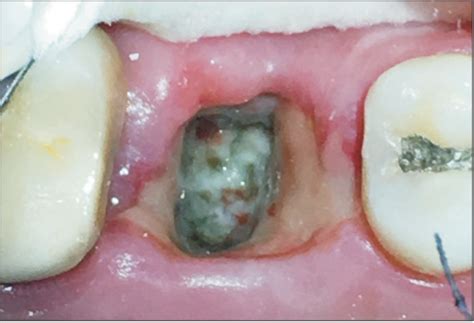 Dry Socket Etiology Diagnosis And Clinical Treatment Techniques