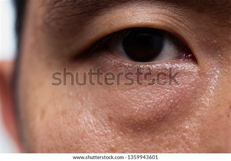 Ptosis Droopy Eyelid Asian Male Oily Stock Photo Edit Now 1359943601