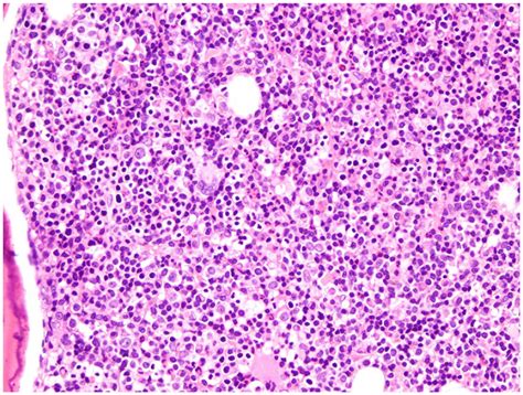 Blurry Vision As A Presentation Of Waldenströms Macroglobulinemia A