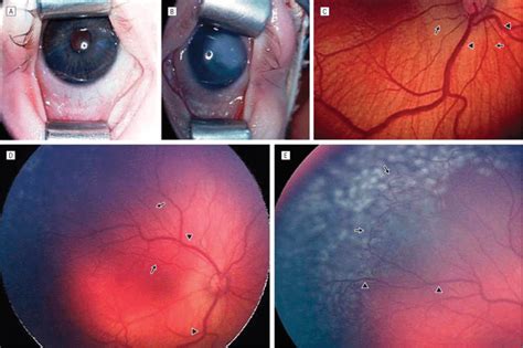 Ocular Findings In A Patient With Adams Oliver Syndrome A Prominent