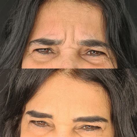 Botox Antes E Depois Em 20 Fotos