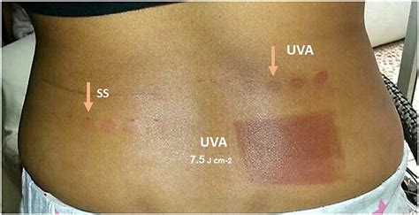 Frontiers Summer And Spring Elbow Rashes Is A Variant Of Polymorphous