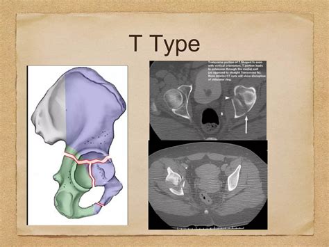 Acetabular Fracture Radiology Xrays Ct Scan And 3d Printing Ppt