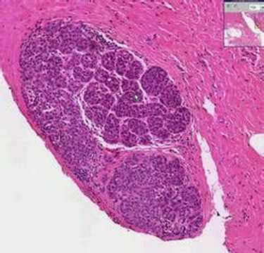 Histopathology Breast Lobular Carcinoma In Situ Youtube