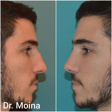 Rinoplastia Antes y Después Rinoplastia en Hombres