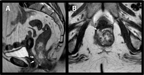 Image Guided Pelvic Exenteration Preoperative And Intraoperative