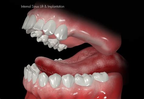 Bone Graft Swansea Sinus Lift Dental Implants Swansea