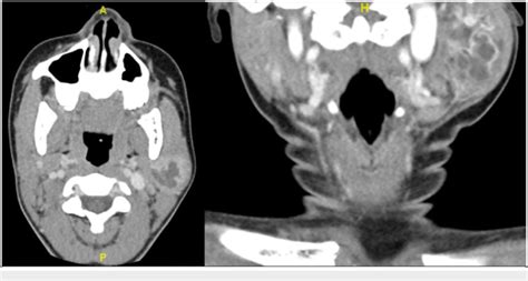 Computed Tomography Ct Images Of Chronic Sclerosing Sialadenitis