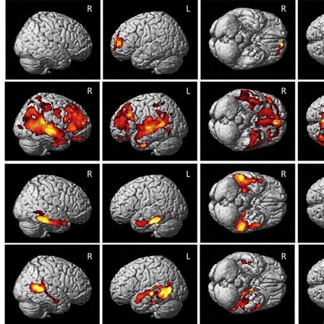 Voxelwise relationship between plasma Aβ measures and cerebral amyloid