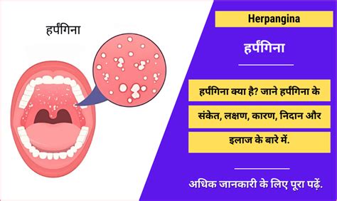 हर्पंगिना - Herpangina in Hindi, Symptoms, Causes, Diagnosis, Treatment