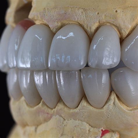 Implanturi Dentare Pret Implant Dentar Implantologie Smilemed