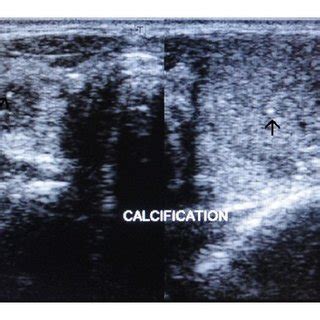 Axial ultrasound images taken just above the level of thyroid isthmus... | Download Scientific ...