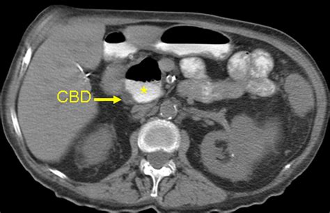 Duodenal Diverticula Potential Complications And Common Imaging