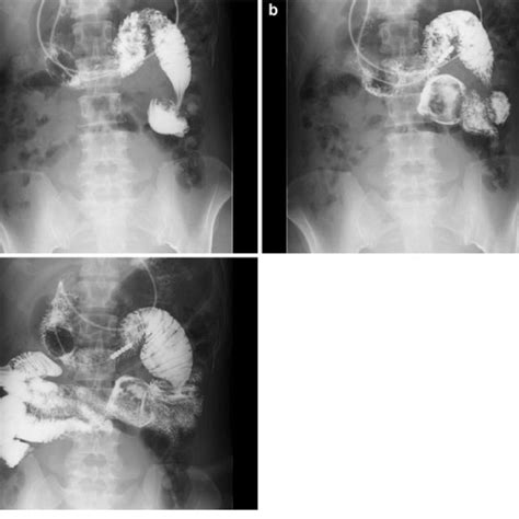 Double Contrast Study Of The Small Intestine A In The Distal Side Of