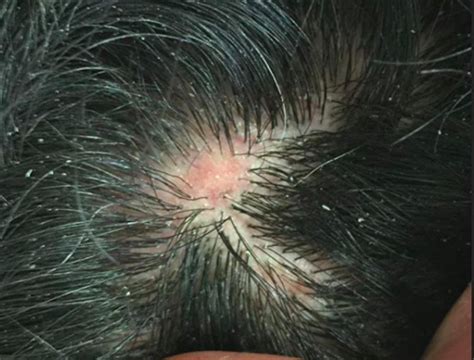 Dissecting Cellulitis Early Disease Can Look Like Alopecia Areata — Donovan Hair Clinic