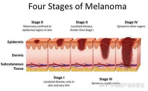 北京大学肿瘤医院教授解读中国恶性黑色素瘤的治疗和生存现状 知乎
