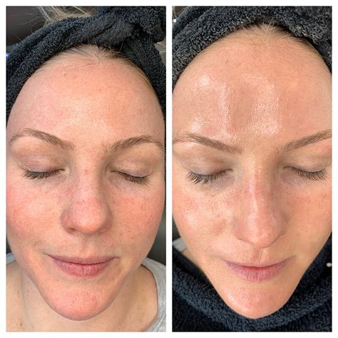 Best HydraFacial In Denver HydraFacial Before And After Mooi