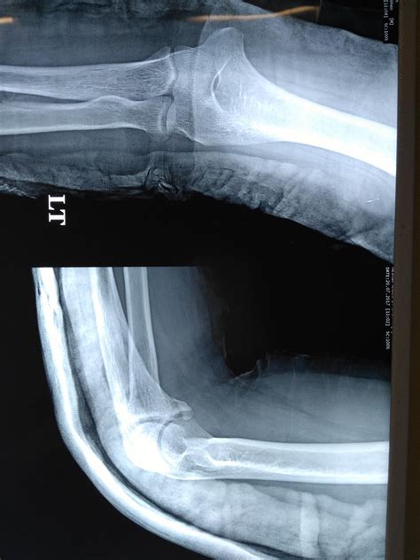 Coronoid Fractures Trauma Orthobullets