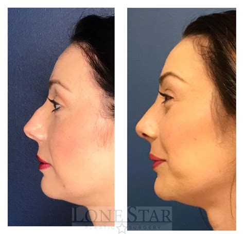 Deviated Septum Nose Job Before And After Hildegard Marks