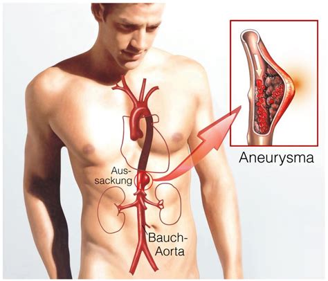 Aortenaneurysma Informationen Spezialisten Finden