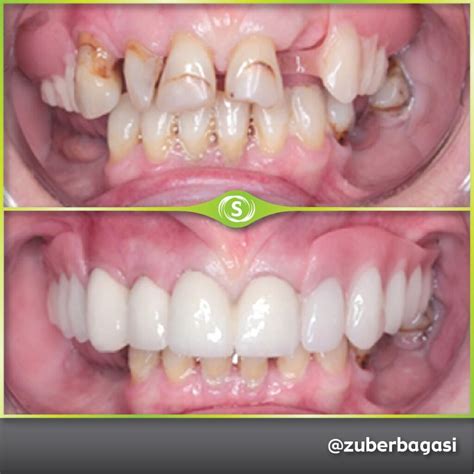 Before and After Full/Partial Dentures • Synergy Dental Clinic