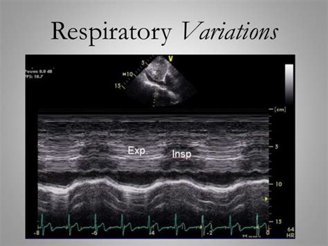 The Evolving Role Of Echocardiography In Sepsis