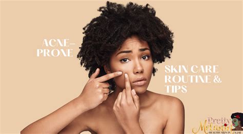 Dos And Donts For Acne Prone Skin Skincare Routine And Tips