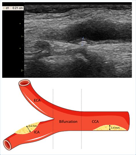 Carotid Plaque Score For Stroke And Cardiovascular Risk Prediction In A Middle‐aged Cohort From