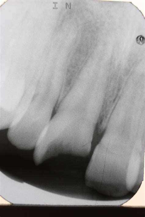 Frontzahntrauma (2) - DocCheck