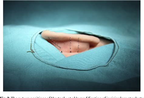 Figure 2 From Comparison Of Two Incisionless Otoplasty Techniques For