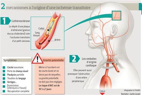 Accident Vasculaire C R Bral Avc Quelles Causes Fiches Sant Et