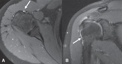 Vessels Adjacent To The Long Head Of The Biceps Tendon Arrows