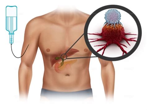 Bile Duct Cancer Treatment With Immunotherapy