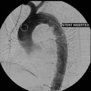 Digital Subtraction Angiogram Obtained After Endovascular Stent Graft