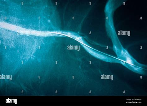 Vertebral Artery Post Angioplasty X Ray Digital Angiogram Of A